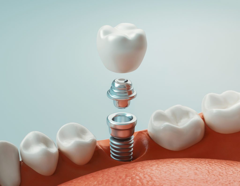 Dental Implants in Bryn Mawr, Pennsylvania